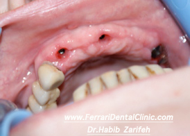 Reffered implantation after bone graft
