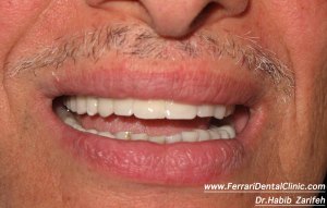 Full bridge ceramic on implants in lebanon Beirut