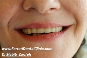 Full ceramic bridge on implant