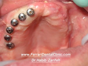 Full mouth flapless surgery
