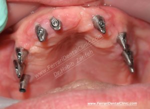 computerized dentistry impression for implants