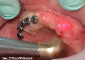 dental implants Beirut