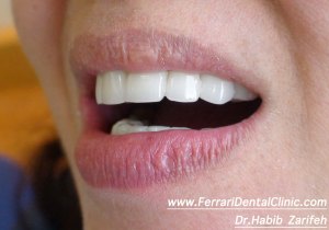 Zirconium bridge on implant in Beirut Lebanon