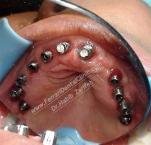 Total mouth dental implants in Lebanon under general anesthesia