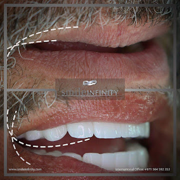 Smile Lift Lebanon after result Dr Habib Zarifeh facial rejuvenation