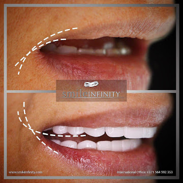 Smile Lift registered trademark Lebanon case Dr Habib Zarifeh