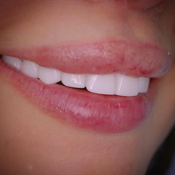 Smile Lift Lebanon facial treatment result Dr Habib Zarifeh