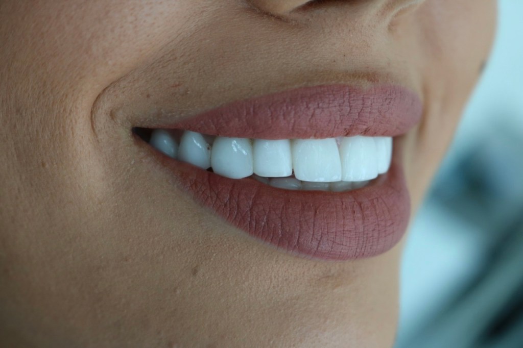 Hollywood smile after transformation Lebanon Beirut Dr Habib Zarifeh