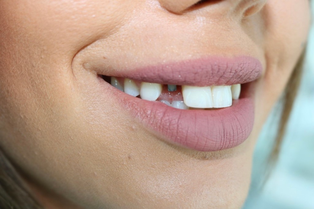 Hollywood smile before Lebanon Beirut patient Dr Habib Zarifeh dental implants