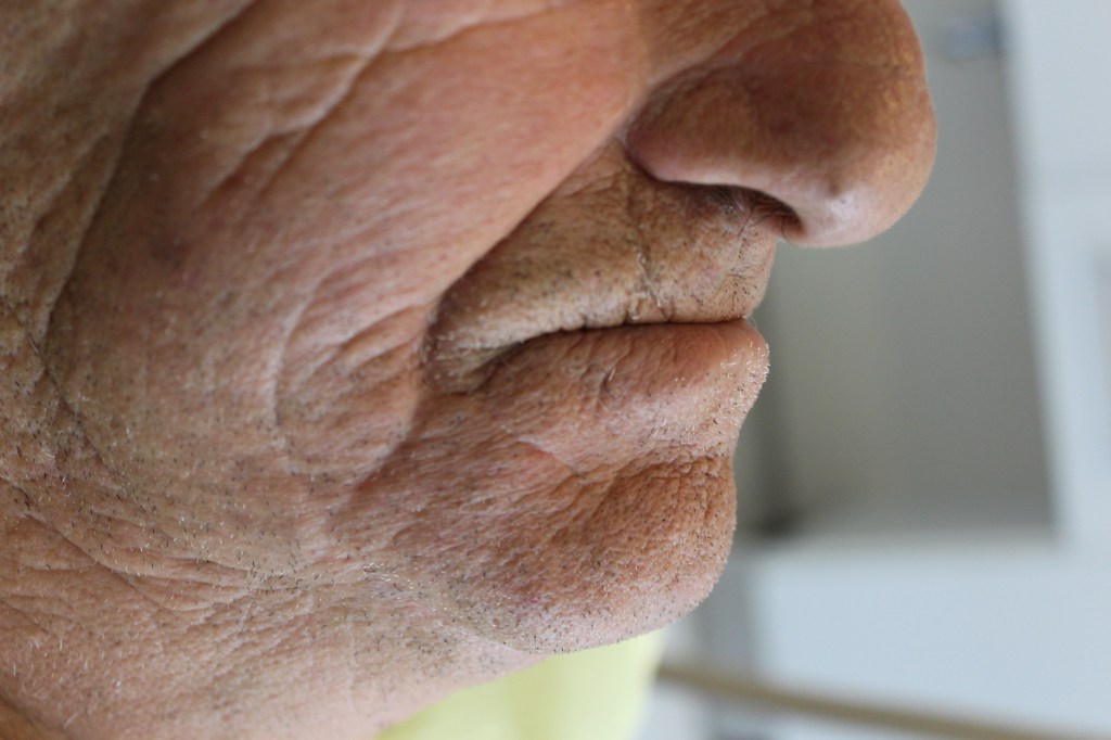 dental implants before photo Lebanon Dr Habib Zarifeh