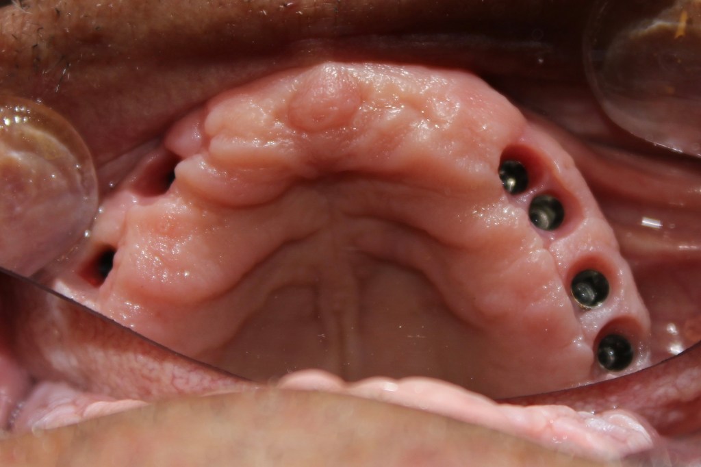 dental implant surgery during procedure Lebanon Beirut One Day Implant Dr Habib Zarifeh