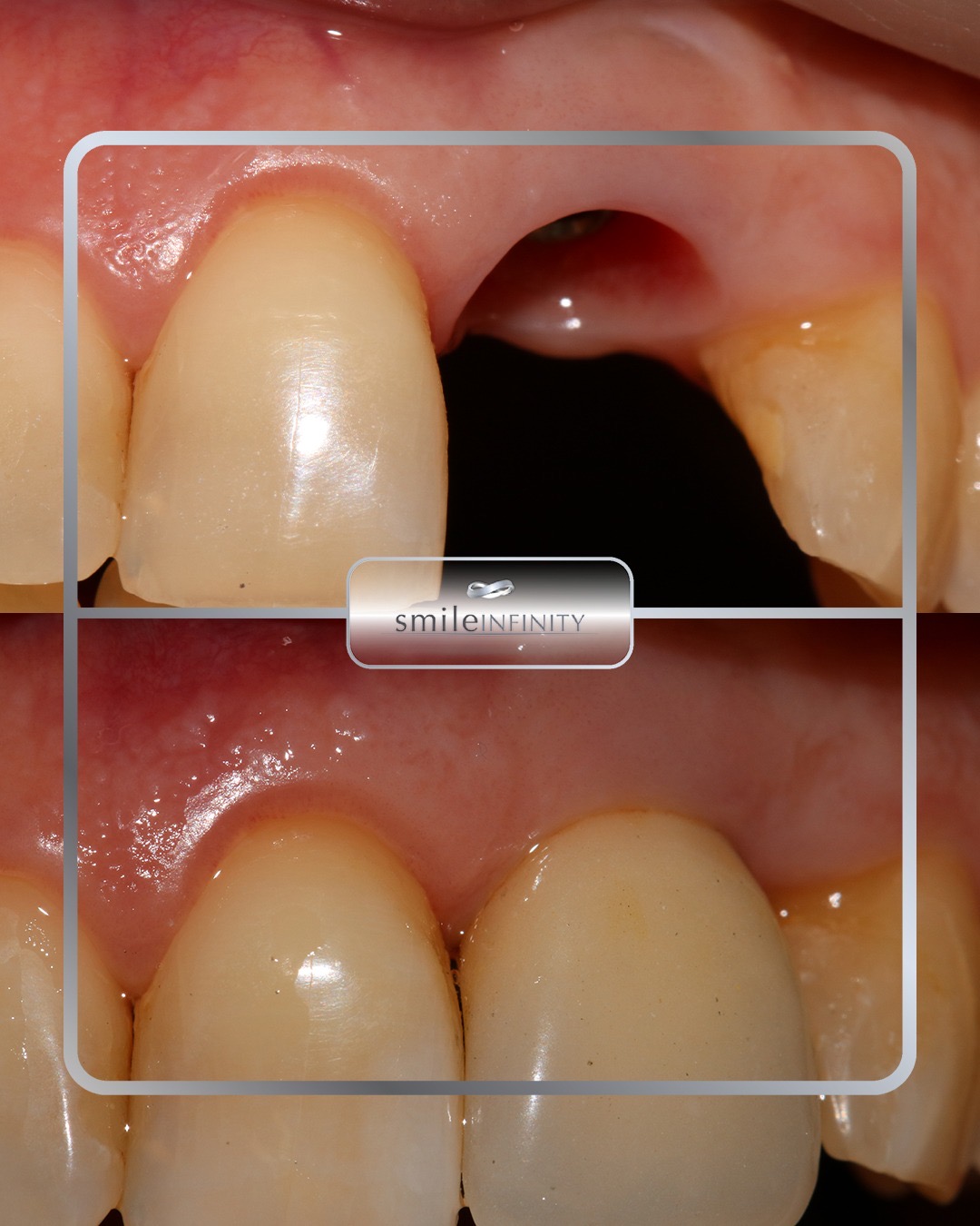 Dental implant in the aesthetic zone anterior tooth replacement Dr Habib Zarifeh Beirut Lebanon