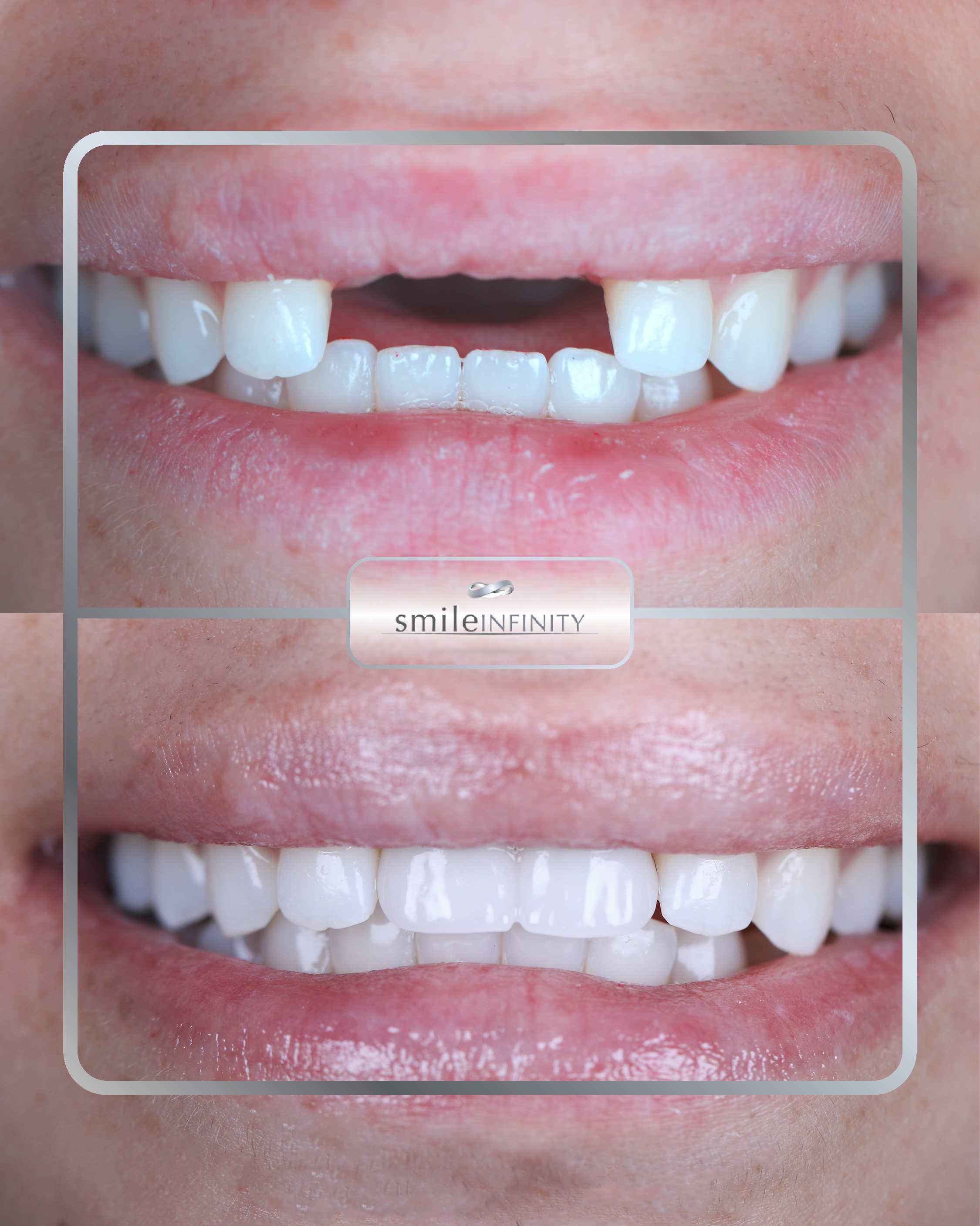Full-arch dental implants before and after &mdash; full mouth rehabilitation by Dr. Habib Zarifeh, Beirut, Lebanon