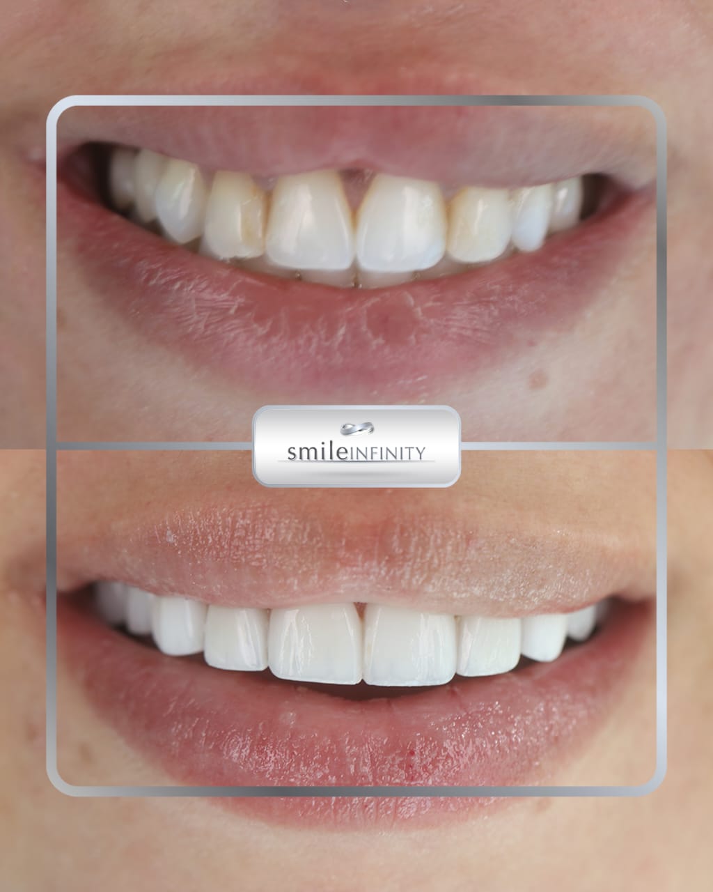 Lumineers by Cerinate before and after &mdash; no-prep veneers by Dr. Habib Zarifeh, Smile Infinity&reg;, Beirut, Lebanon
