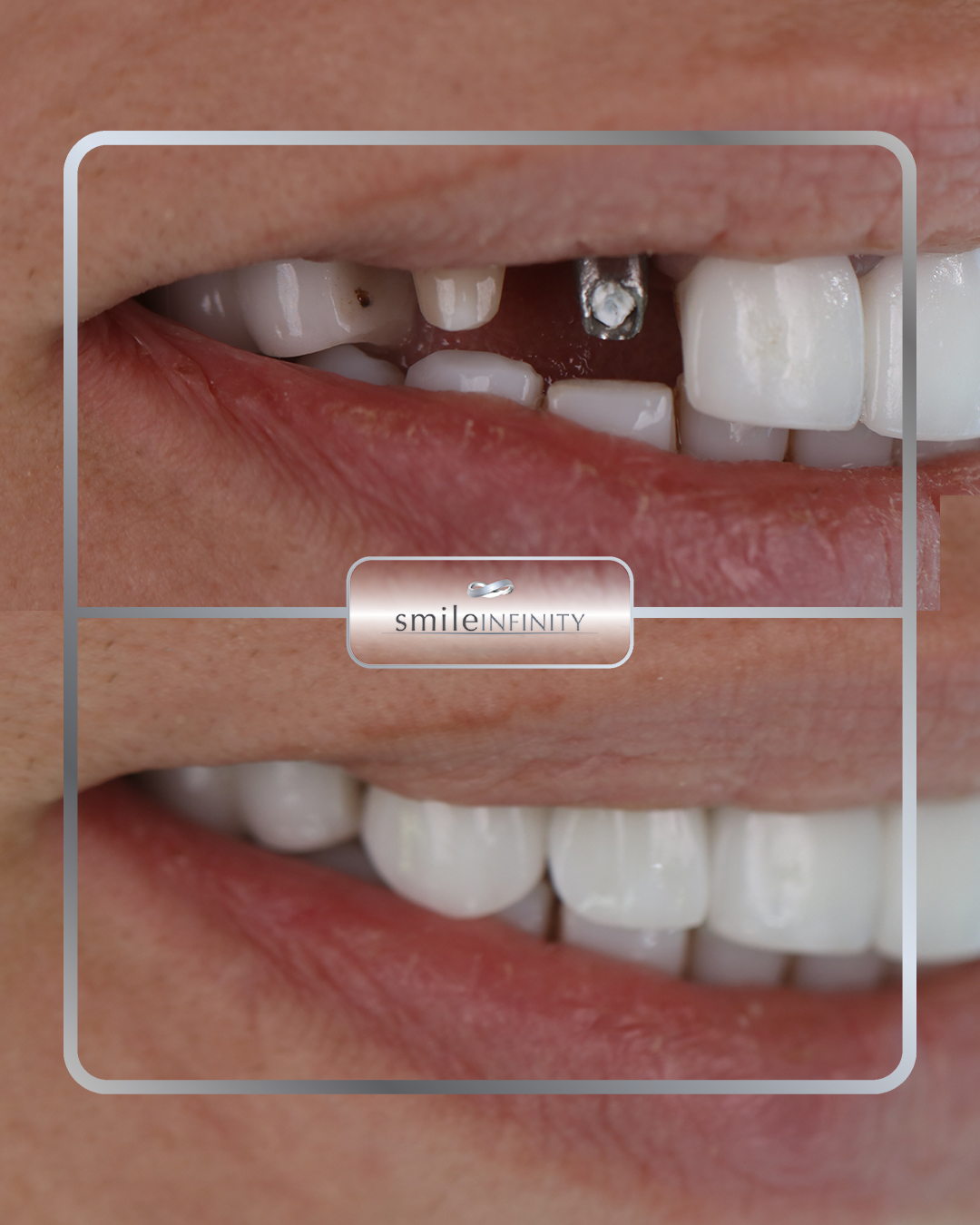 One Day Implant&reg; abutment &mdash; single-tooth dental implant before and after by Dr. Habib Zarifeh, Beirut, Lebanon