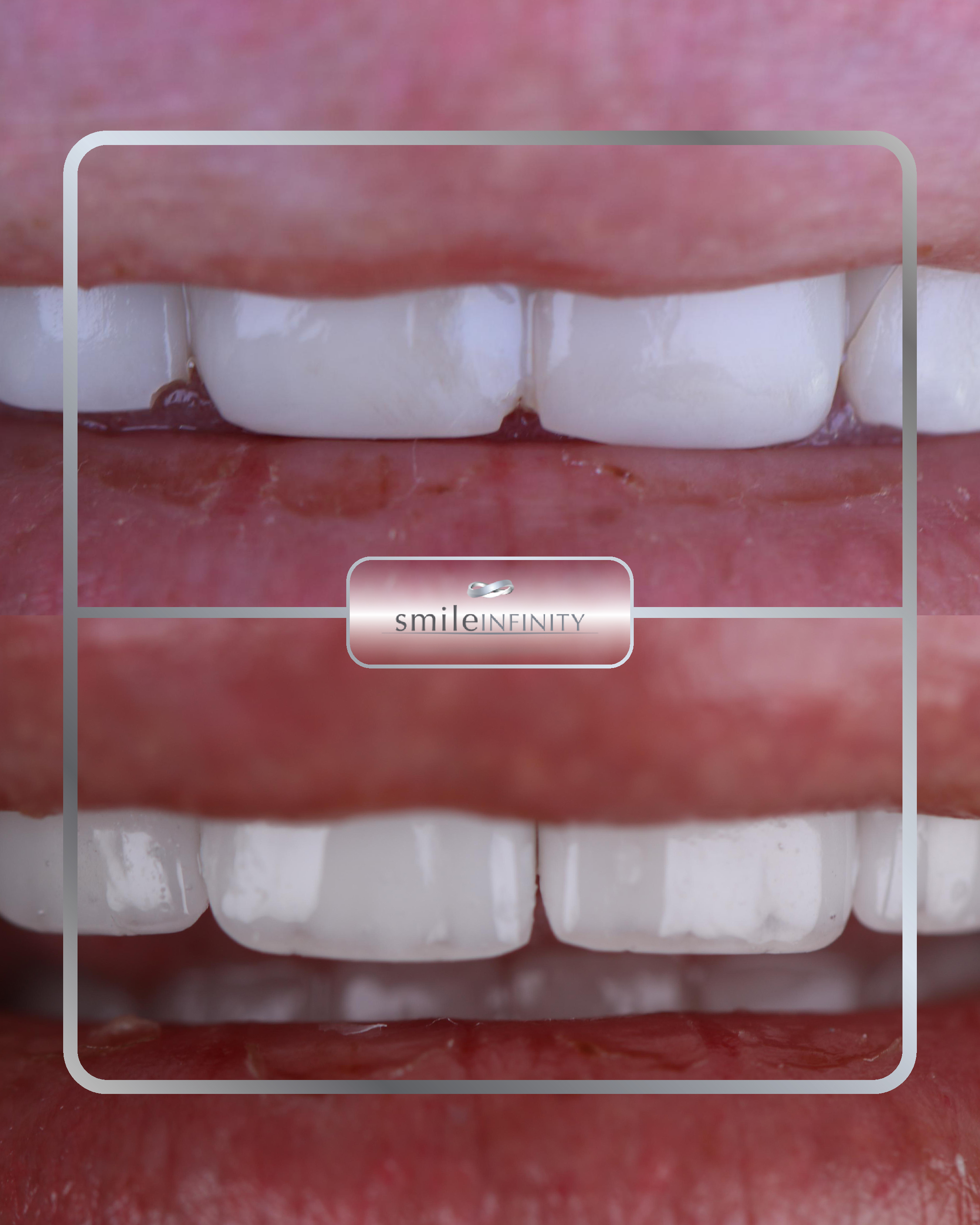 ZEvolution Veneers&reg; before and after &mdash; Hollywood Smile by Dr. Habib Zarifeh, Smile Infinity&reg;, Beirut, Lebanon
